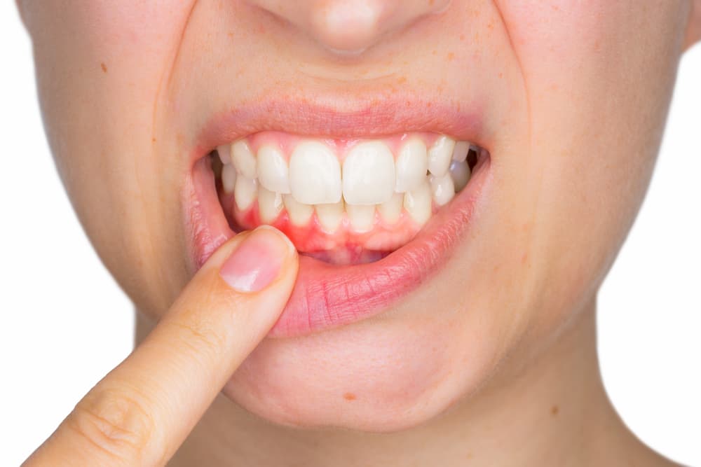 Woman showing her mouth with gum disease