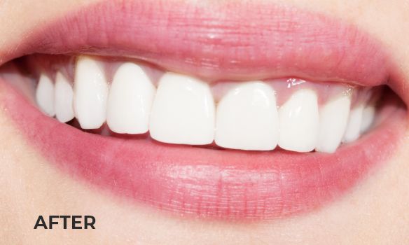 A set of teeth after teeth whitening