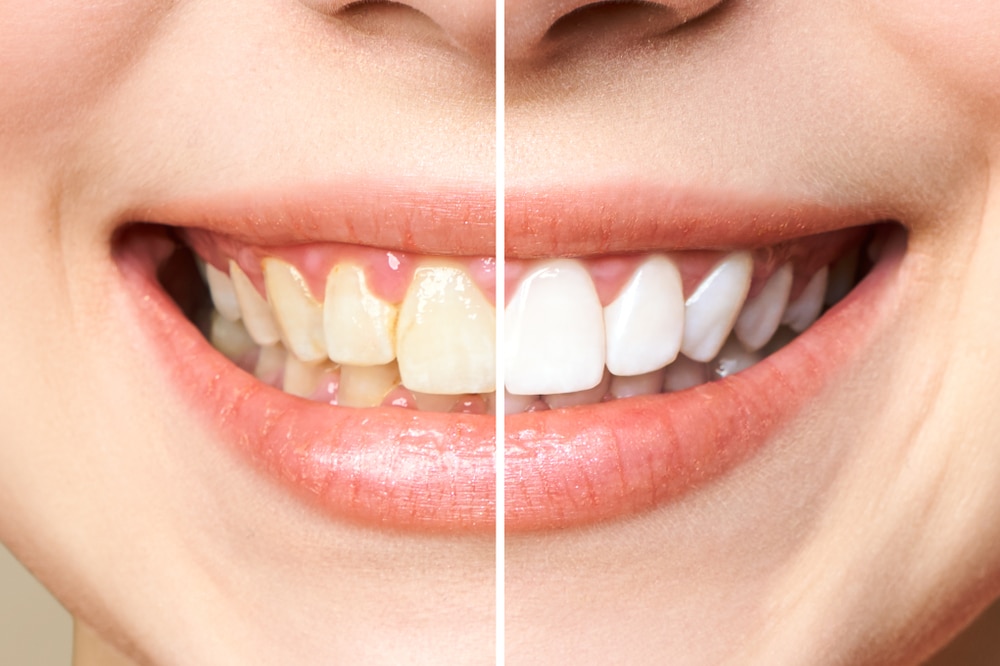 teeth whitening transformation