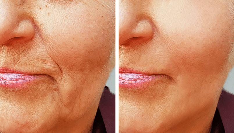 facial filler transformation