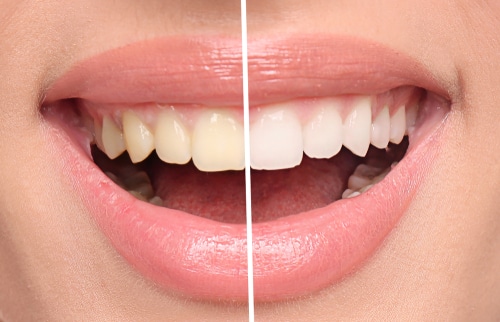 teeth whitening transformation