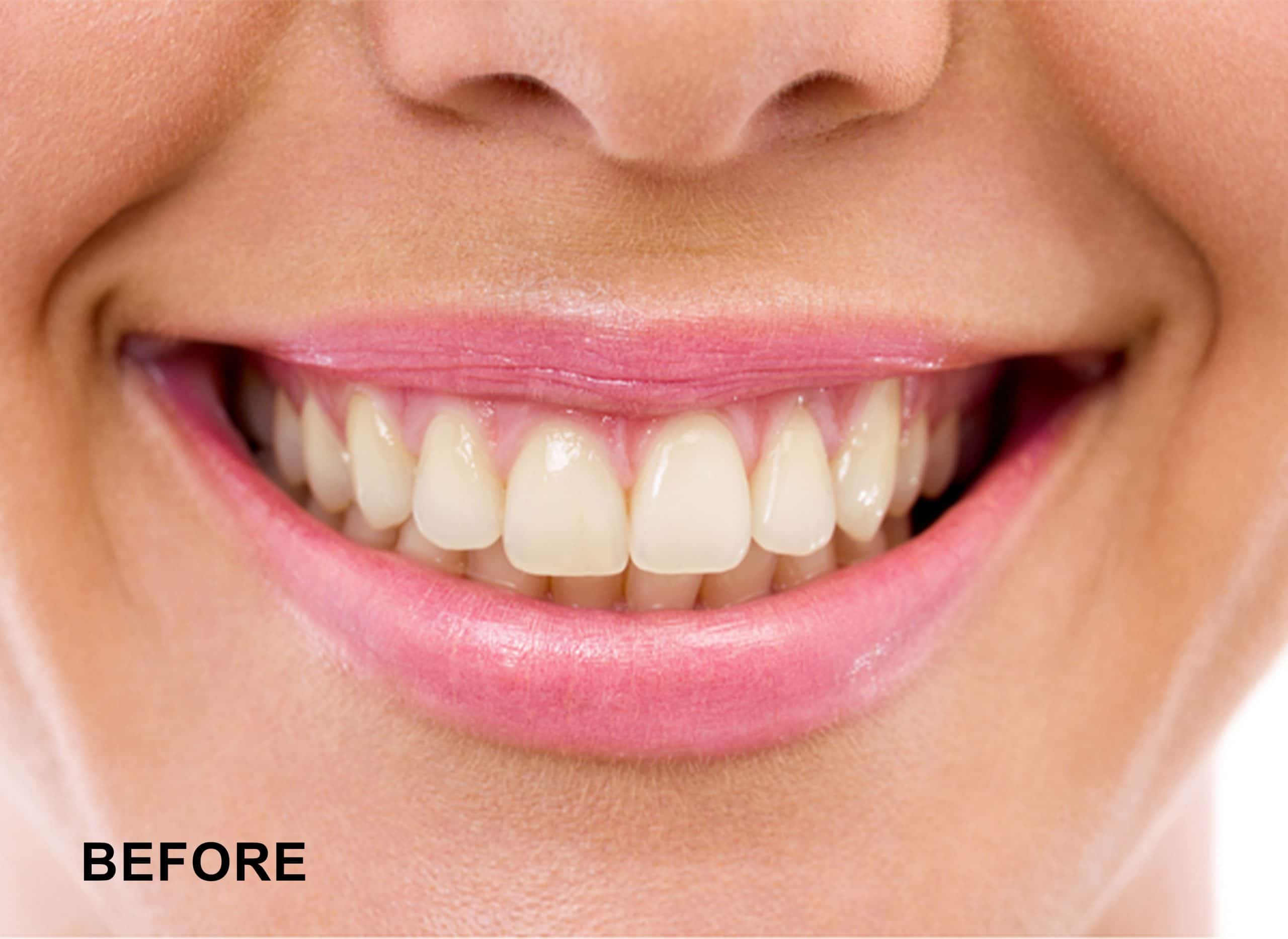 teeth before having whitening treatment
